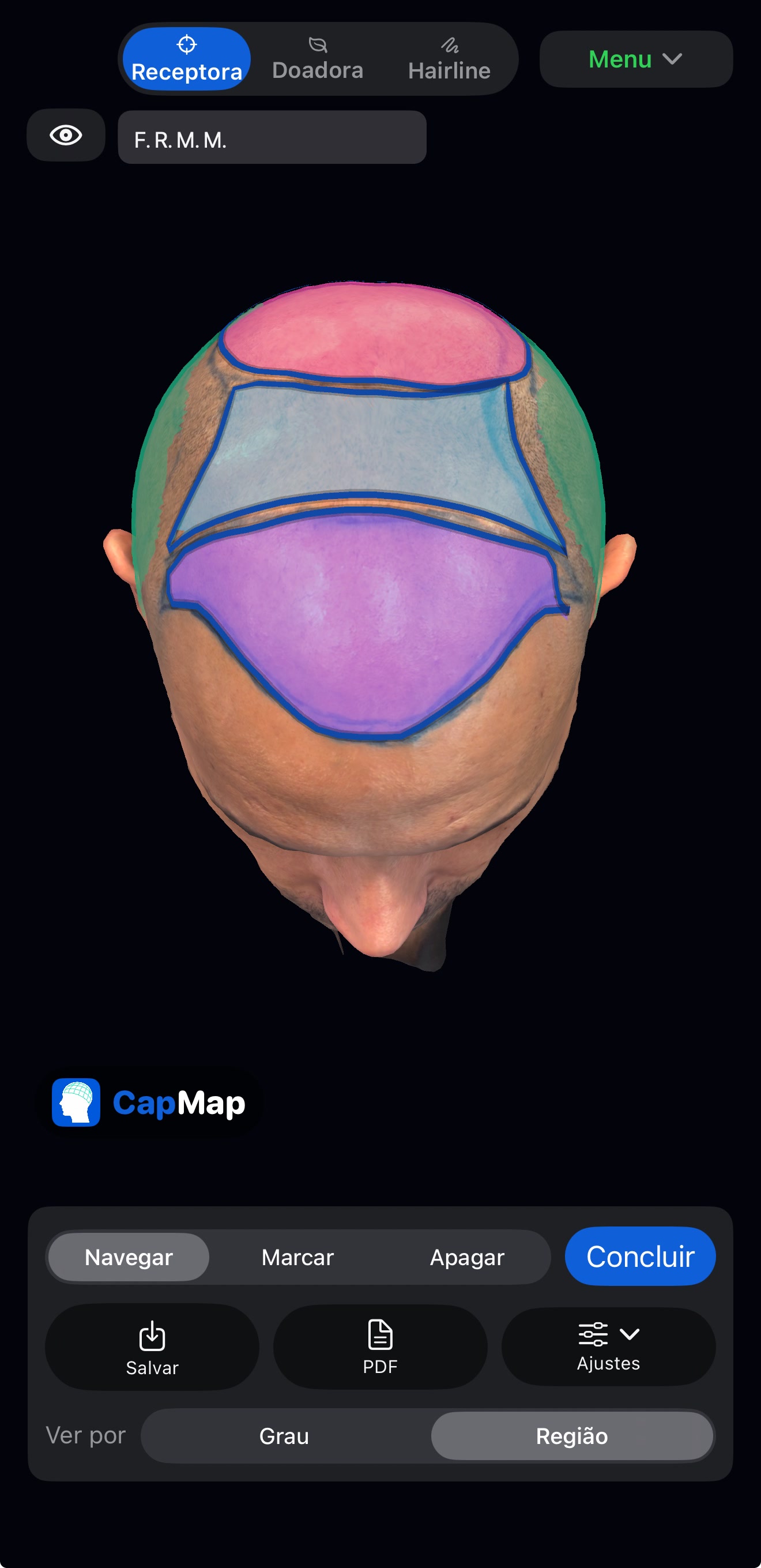 Tela sanitizada do app CapMap com regiões clínicas coloridas sobre o modelo 3D, sem identificação do paciente.